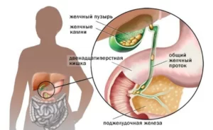 Желчекаменная болезнь